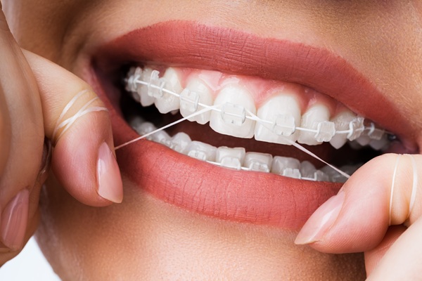 Proper Care For Clear Braces