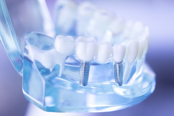 Can Multiple Dental Implants Be Placed At The Same Appointment?