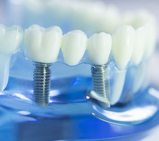 Belleville Dental Implants