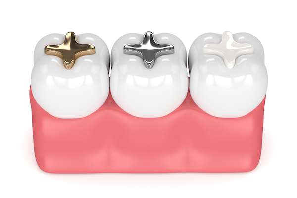 A General Dentist Discusses Different Filling Options from Keep Smiling Dental PC in Belleville, NJ